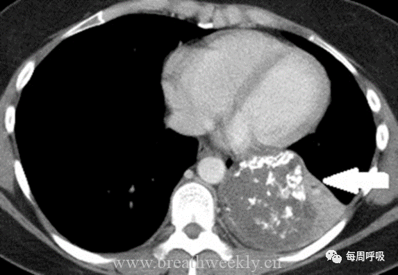 图片[6]-肺部钙化性疾病有哪些? | 每周呼吸-每周呼吸