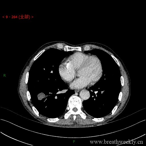图片[13]-病例库1 | 每周呼吸-每周呼吸