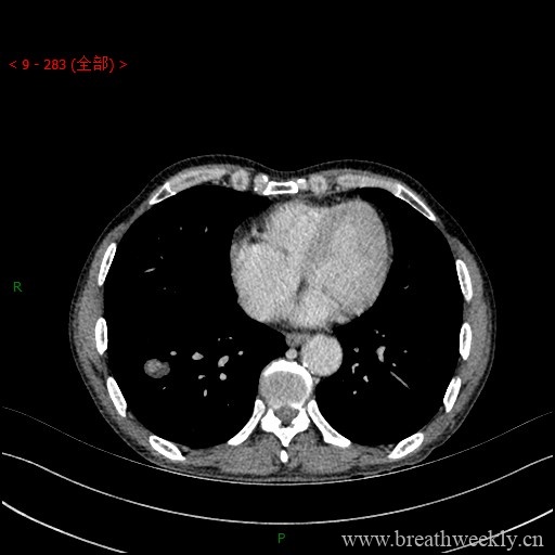 图片[15]-病例库1 | 每周呼吸-每周呼吸