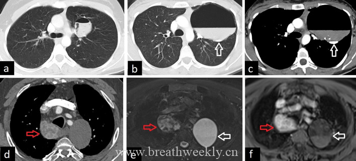 图片[11]-成人肺部先天性疾病影像学图片综述 | 每周呼吸-每周呼吸