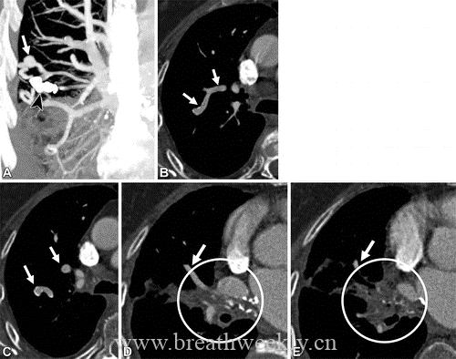 图片[13]-肺部动静脉畸形的CT表现及其鉴别诊断| 每周呼吸-每周呼吸