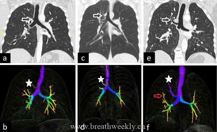 图片[13]-成人肺部先天性疾病影像学图片综述 | 每周呼吸-每周呼吸