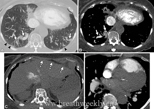 图片[16]-肺部动静脉畸形的CT表现及其鉴别诊断| 每周呼吸-每周呼吸