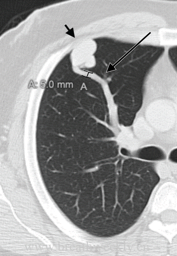 图片[3]-肺部动静脉畸形的CT表现及其鉴别诊断| 每周呼吸-每周呼吸