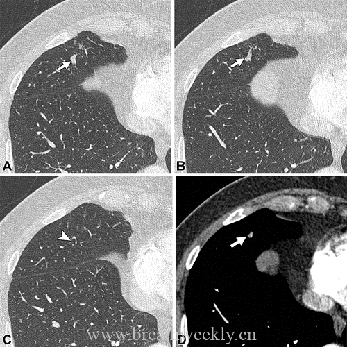图片[23]-肺部动静脉畸形的CT表现及其鉴别诊断| 每周呼吸-每周呼吸
