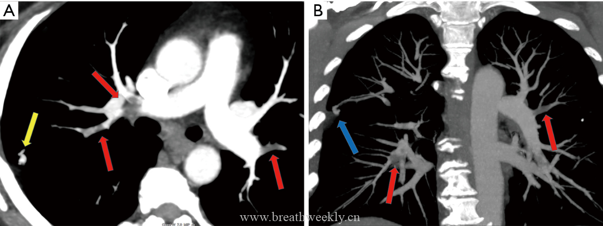 图片[4]-肺部动静脉畸形的CT表现及其鉴别诊断| 每周呼吸-每周呼吸