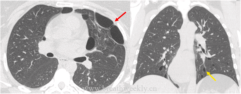 图片[31]-成人肺部先天性疾病影像学图片综述 | 每周呼吸-每周呼吸