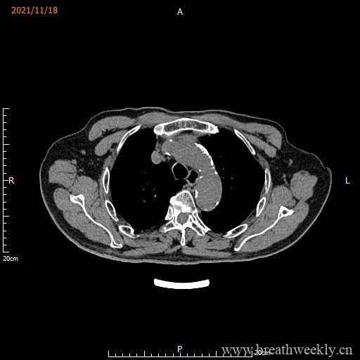 图片[9]-病例库15 | 每周呼吸-每周呼吸