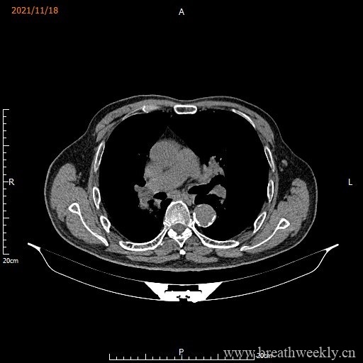 图片[10]-病例库15 | 每周呼吸-每周呼吸