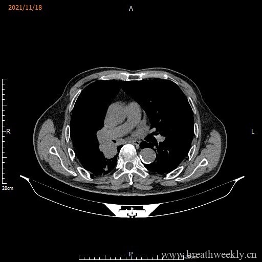 图片[11]-病例库15 | 每周呼吸-每周呼吸
