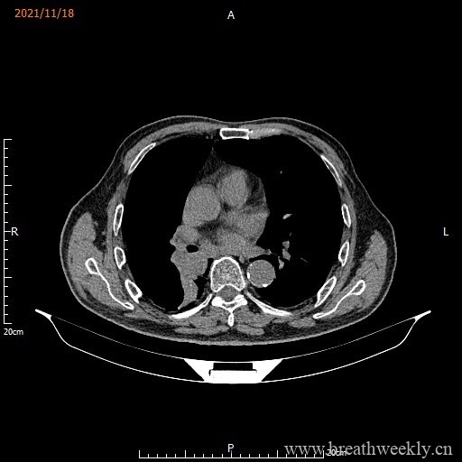 图片[12]-病例库15 | 每周呼吸-每周呼吸