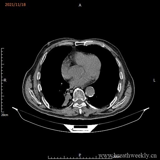 图片[13]-病例库15 | 每周呼吸-每周呼吸