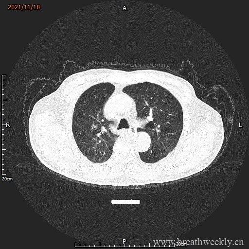 图片[1]-病例库15 | 每周呼吸-每周呼吸