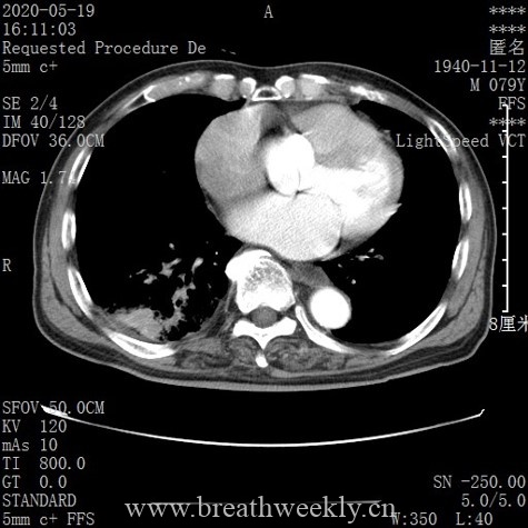 图片[20]-病例库11 | 每周呼吸-每周呼吸