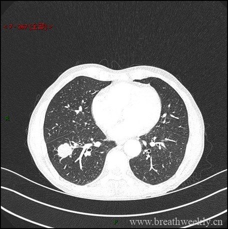 图片[3]-病例库1 | 每周呼吸-每周呼吸