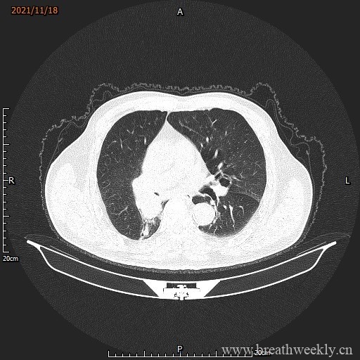 图片[4]-病例库15 | 每周呼吸-每周呼吸