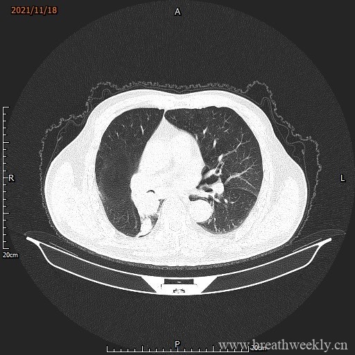 图片[5]-病例库15 | 每周呼吸-每周呼吸