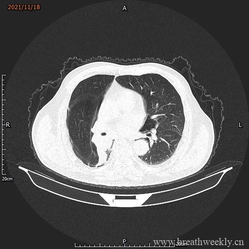 图片[6]-病例库15 | 每周呼吸-每周呼吸