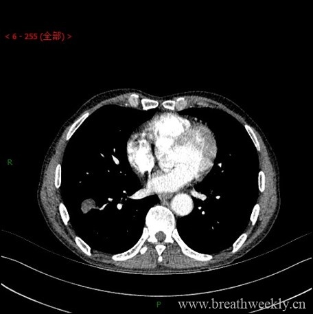 图片[7]-病例库1 | 每周呼吸-每周呼吸