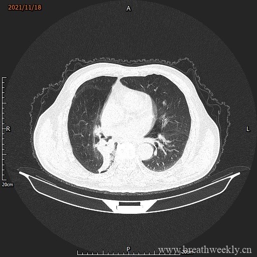 图片[7]-病例库15 | 每周呼吸-每周呼吸