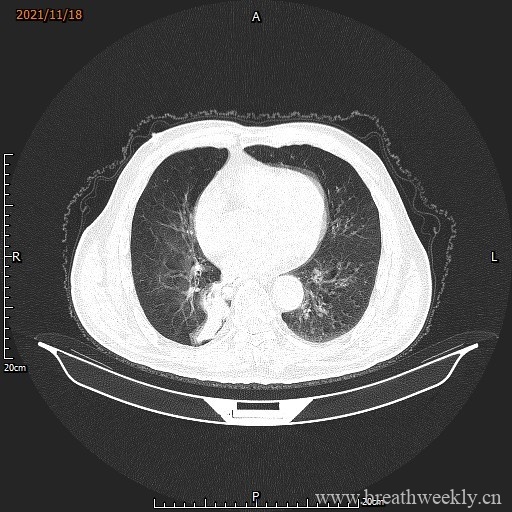 图片[8]-病例库15 | 每周呼吸-每周呼吸