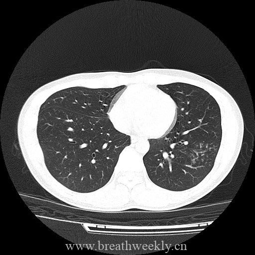 图片[8]-病例库8 | 每周呼吸-每周呼吸