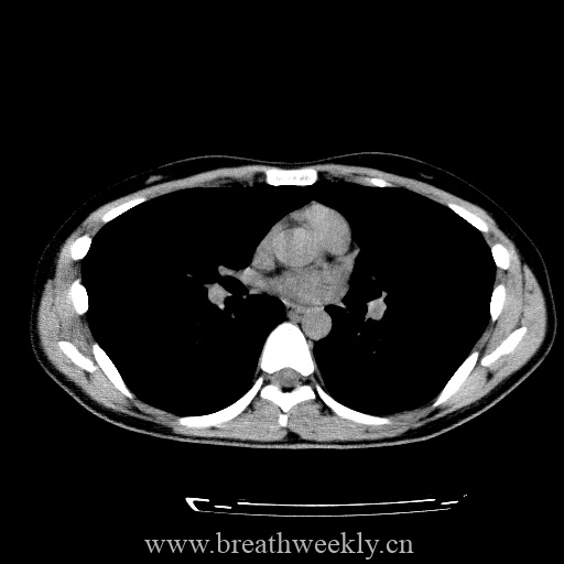 图片[17]-病例库8 | 每周呼吸-每周呼吸