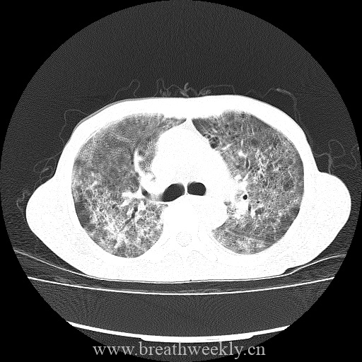 图片[5]-病例库9 | 每周呼吸-每周呼吸