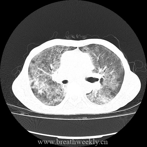 图片[6]-病例库9 | 每周呼吸-每周呼吸