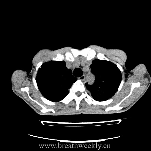 图片[11]-病例库9 | 每周呼吸-每周呼吸
