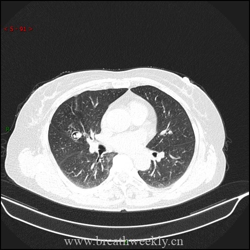 图片[1]-肺曲霉病的典型影像表现 | 每周呼吸-每周呼吸