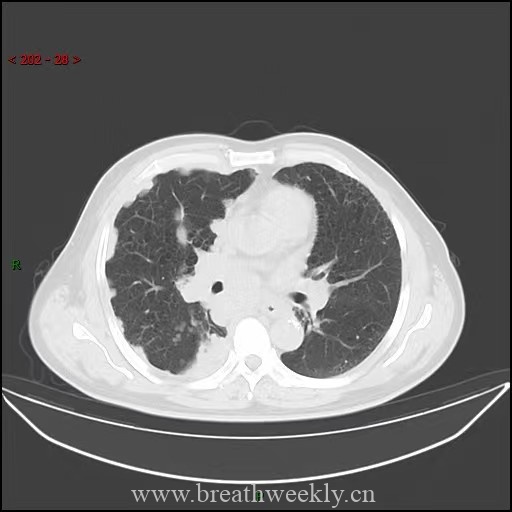 小细胞肺癌影像表现 | 每周呼吸-每周呼吸