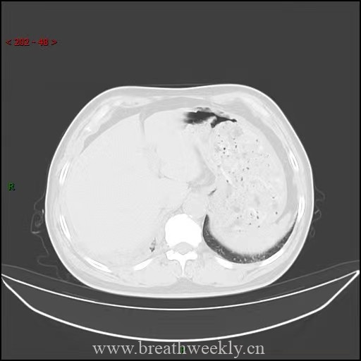 图片[12]-小细胞肺癌影像表现 | 每周呼吸-每周呼吸
