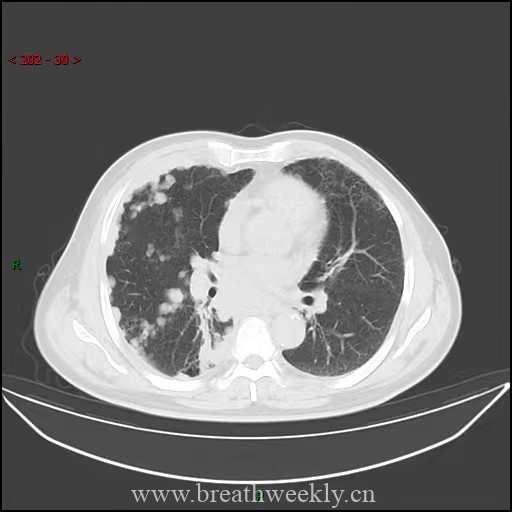 图片[10]-小细胞肺癌影像表现 | 每周呼吸-每周呼吸