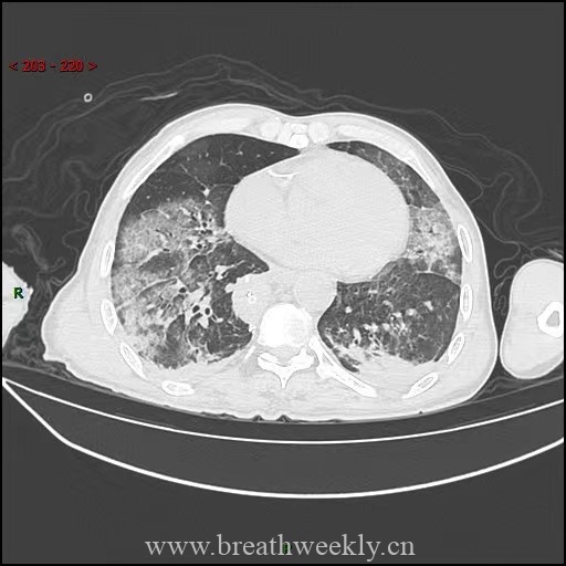图片[4]-病例59 药物相关性肺损伤 | 每周呼吸-每周呼吸