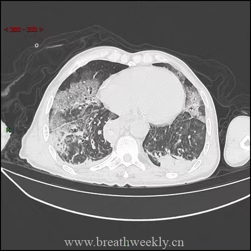 图片[5]-病例59 药物相关性肺损伤 | 每周呼吸-每周呼吸