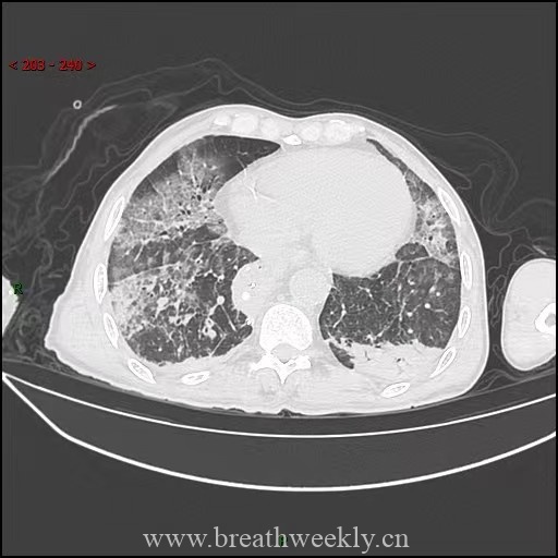 图片[6]-病例59 药物相关性肺损伤 | 每周呼吸-每周呼吸