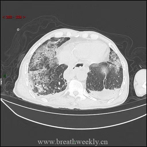 图片[8]-病例59 药物相关性肺损伤 | 每周呼吸-每周呼吸