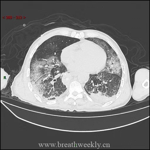 图片[9]-病例59 药物相关性肺损伤 | 每周呼吸-每周呼吸