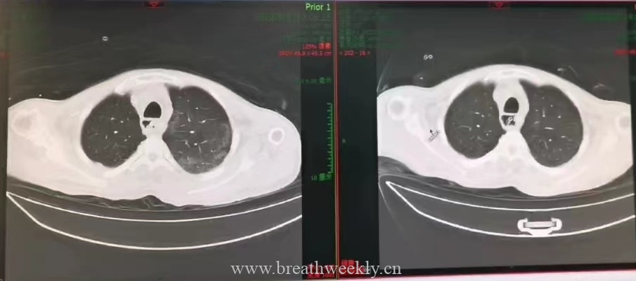 图片[3]-病例59结果 | 每周呼吸-每周呼吸