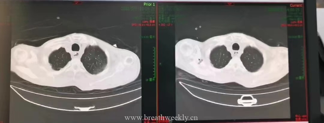 图片[2]-病例59结果 | 每周呼吸-每周呼吸