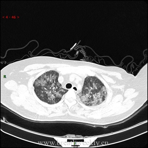 图片[1]-病例59 药物相关性肺损伤影像表现 | 每周呼吸-每周呼吸
