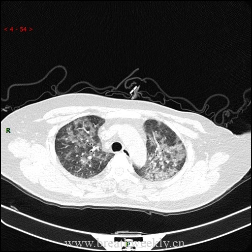 图片[2]-病例59 药物相关性肺损伤影像表现 | 每周呼吸-每周呼吸
