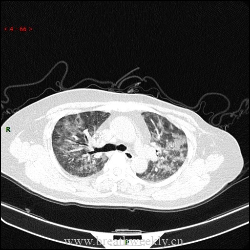 病例59 药物相关性肺损伤影像表现 | 每周呼吸-每周呼吸