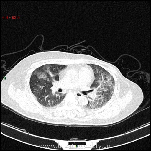 图片[4]-病例59 药物相关性肺损伤影像表现 | 每周呼吸-每周呼吸