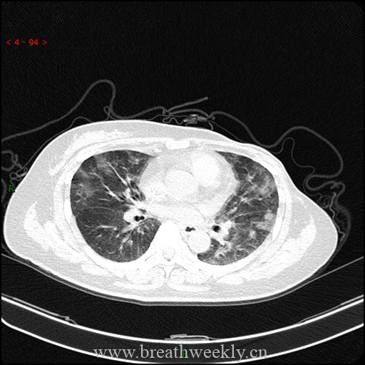 图片[5]-病例59 药物相关性肺损伤影像表现 | 每周呼吸-每周呼吸