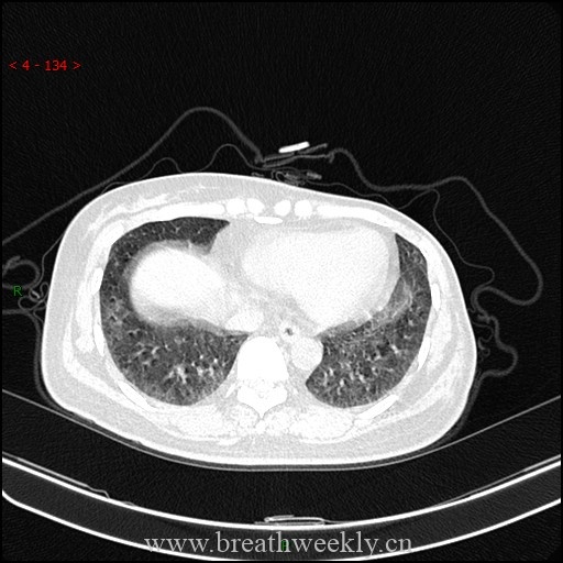 图片[7]-病例59 药物相关性肺损伤影像表现 | 每周呼吸-每周呼吸