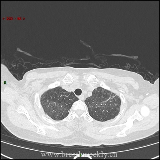 图片[2]-病例57 药物性肺损伤影像读片 | 每周呼吸-每周呼吸