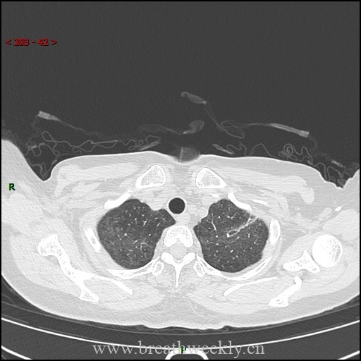 图片[1]-病例57 药物性肺损伤影像读片 | 每周呼吸-每周呼吸