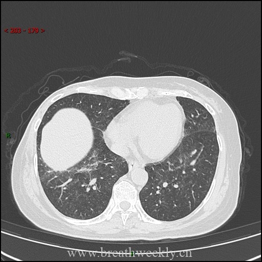 图片[13]-病例57 药物性肺损伤影像读片 | 每周呼吸-每周呼吸